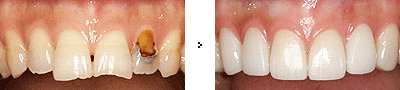 Also known as cavities