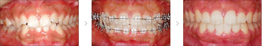 Labial