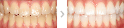 Whitening