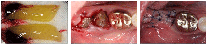 What does it cost to remove wisdom teeth?